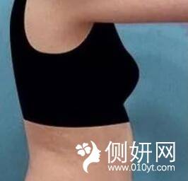 重庆医科大学附属第一医院整形美容科做的腰部吸脂摆脱水桶腰的烦恼