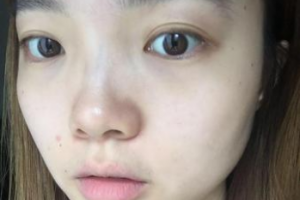 芜湖二院整形美容科价格表曝出，附激光去眼袋手术案例