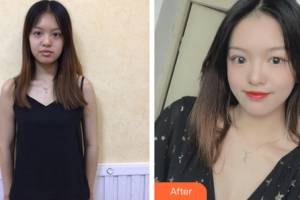 杭州艺星医疗美容门诊部万连壮整形价格表附隆胸手术案例展示