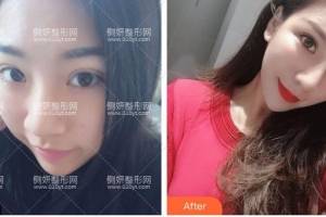 河北医科大学第二医院整形美容科张卓男假体隆鼻怎么样附最新价格表