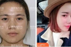 安徽省立医院整形美容科赵李平双眼皮手术怎么样附最新价格表