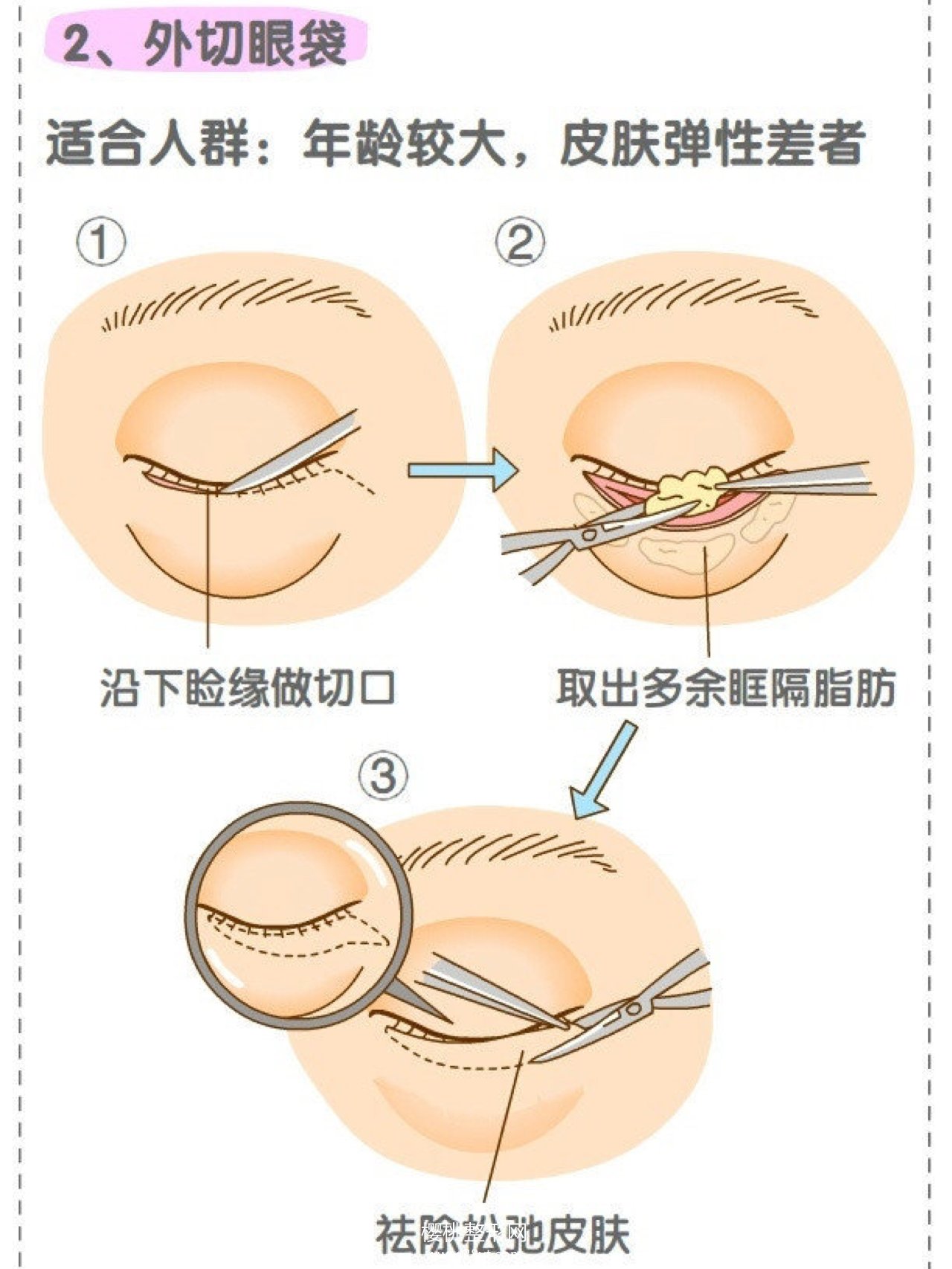 怎样才能消除眼袋？祛眼袋的方法汇总