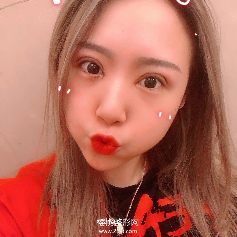 福州美莱华美吴正思双眼皮案例+2021双眼皮价格表一览