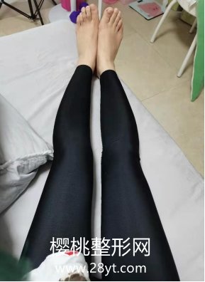 佛山君美医疗美容医院的抽脂效果怎么样?大腿吸脂案例分享