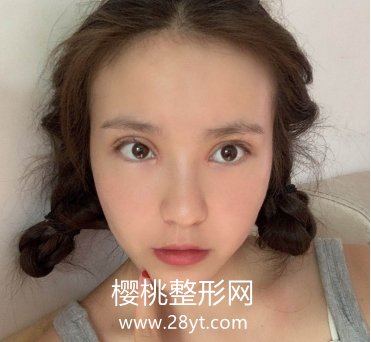 海南瑞韩医学美容医院是正规的吗?双眼皮真人案例展示+2021价格表