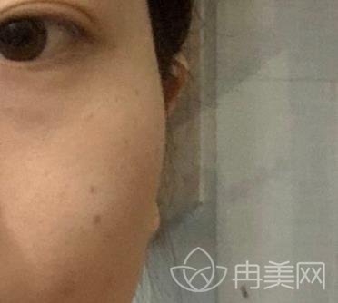 南昌一附院整形美容科价格表更新，附激光点痣日志