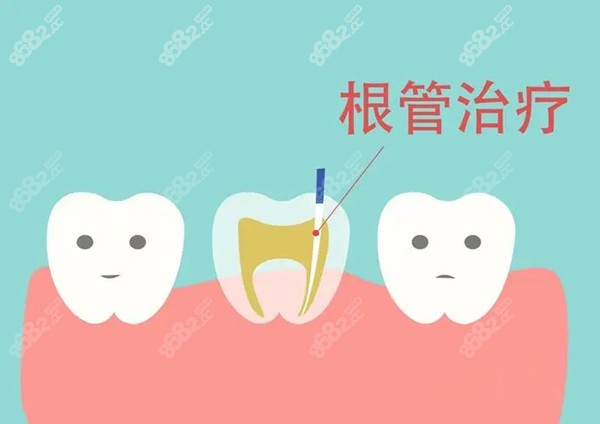 合肥根管治疗多少钱一颗牙 顺带分享牙疼去合肥哪个牙科好