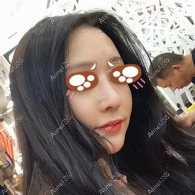 找党宁医生做肋软骨隆鼻已经4个月了,这小翘鼻我真的好喜欢