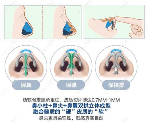 邓东伟8C骨雕隆鼻，鼻头可以揉捏