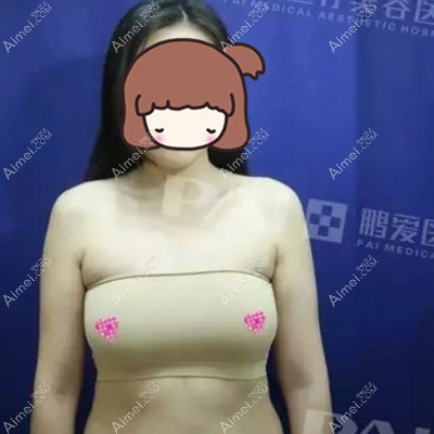 隆胸后因哺乳胸下垂，取出在长沙鹏爱重新做了320cc蓓菈假体