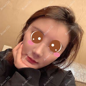 找郑荃医生做脂肪修复术后62天