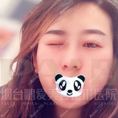 双眼皮修复术前对比_meitu_1