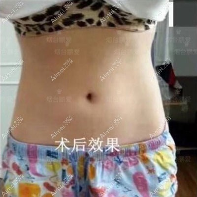 腰腹环吸术后效果图