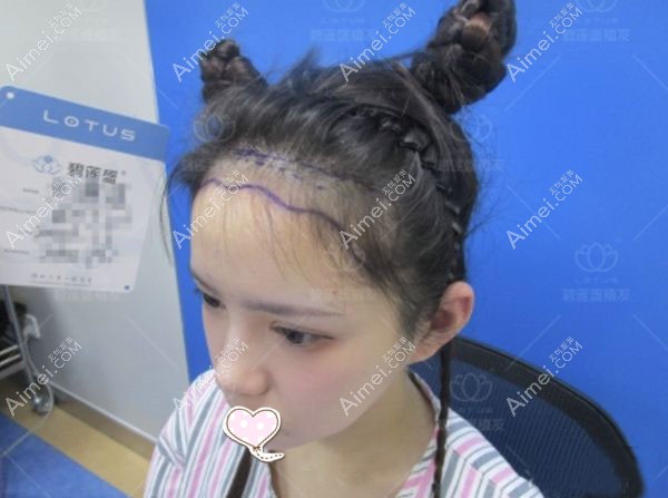 不剃发种植发际线1000单位术前照片.jpg