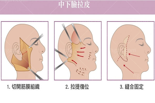 中下脸拉皮手术示意图