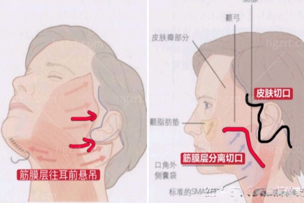 拉皮手术提升区域示意