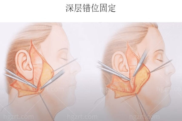 一些拉皮医生研发的错位固定紧致手法