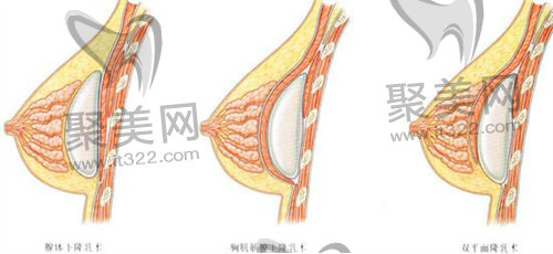 假体隆胸