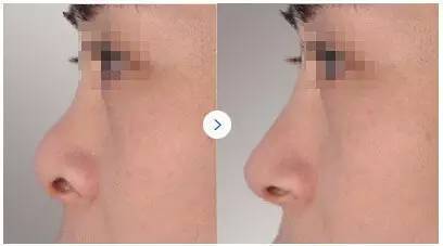 影响隆鼻的*因素有哪些？尽美整形网