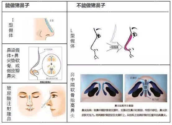 隆鼻后不能揉来揉去？