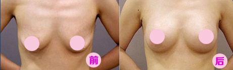 乳房下垂矫正手术多久可以见*？