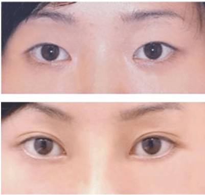 埋线双眼皮、韩式定点和全切双眼皮哪种更适合