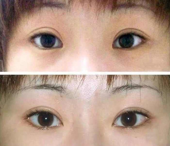 开眼角后疤痕增生可以修复吗？