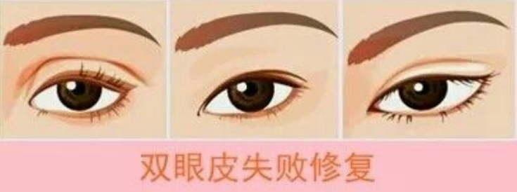 北京双眼皮修复整形医院医生对比分析