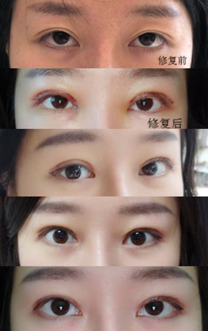 在成都天之美刘宁那里做的双眼皮修复，130天了