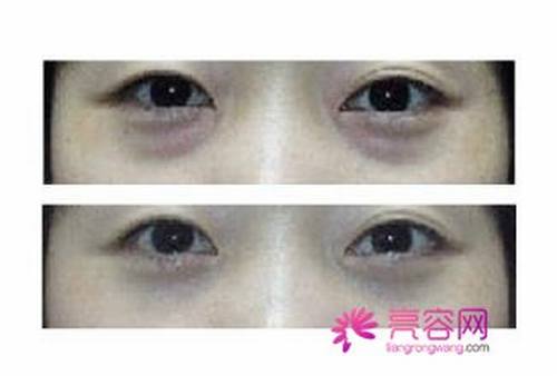 去除眼袋手术后需要多长时间才能恢复正常呢?