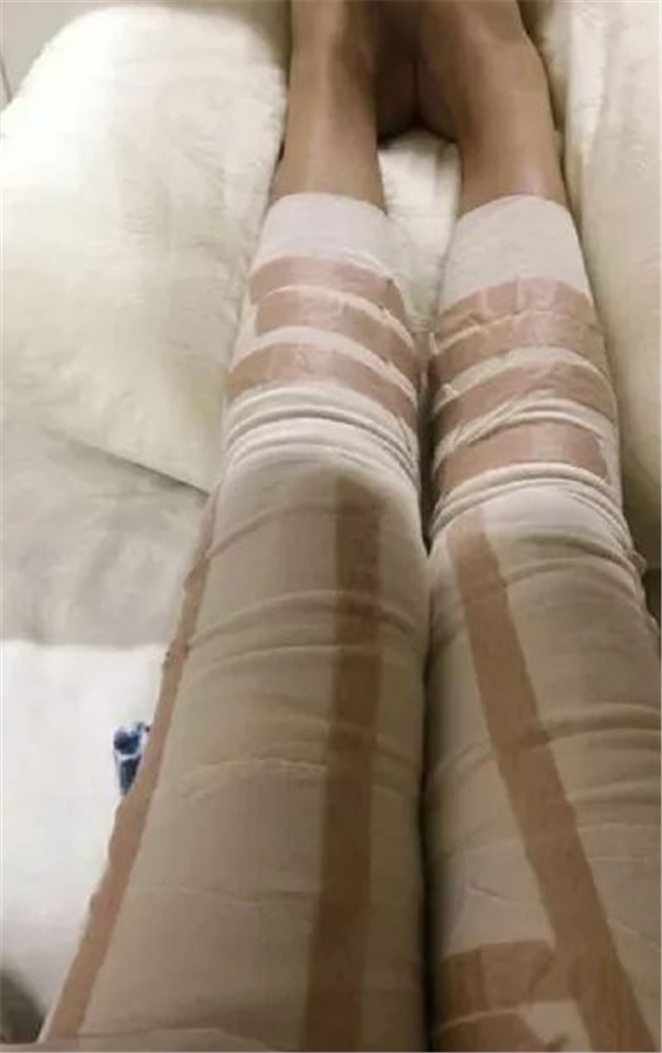 北京东方和谐孙泽芳抽脂术后果怎么样?案例_价格_口碑