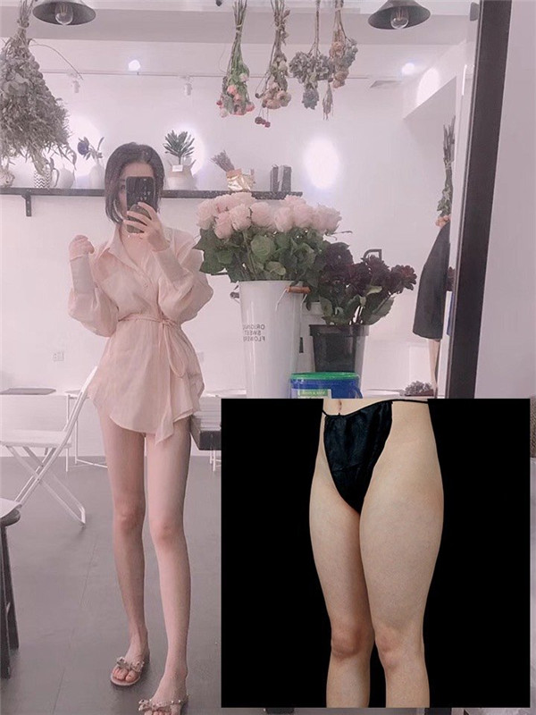 上海德琳朱麟抽脂术后果怎么样?案例,价格,口碑