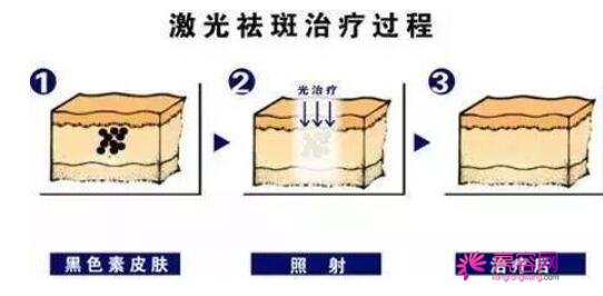 脸上长斑是因为什么原因引起的呢？如何治疗脸上长斑呢？【科普】