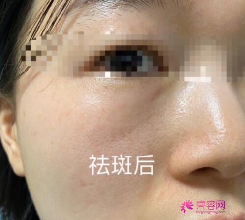 祛斑较好的方法目前较有的是什么呢？激光祛斑没问题吗？