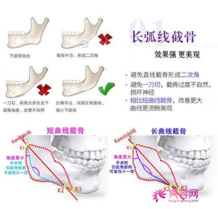 韩国卢相勋整形外科卢相勋技术怎么样？医生简介+下颌角磨骨案例