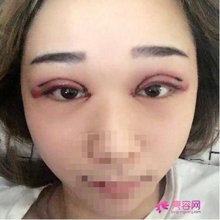 西安晗美整形徐艳眼部手术怎么样？医生信息简介+真人案例体验分享