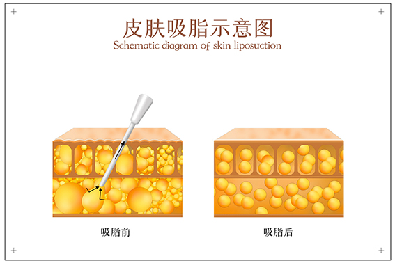 吸脂瘦全身靠谱吗？术后应该注意些什么？