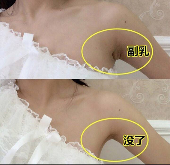 吸脂去副乳效果好不好？吸脂去副乳要注意哪些问题？