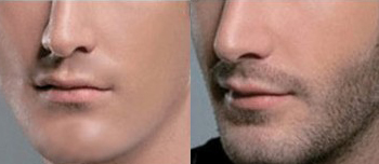 胡须种植前后对比图