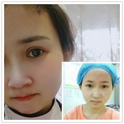 分享荆州真人做切开双眼皮过程及一个月对比图