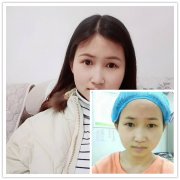 【真人案例】分享荆州医院导诊做切开双眼皮前后护理总结