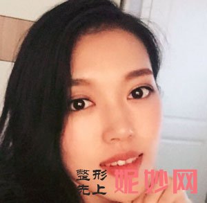 北京美莱医疗美容叶宇医生做眼部多项怎么样？真人案例对比图分享！