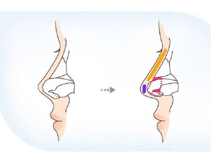 手术延长鼻小柱