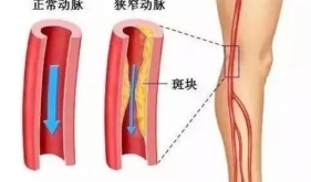 腿脚疼痛、麻木、发凉？警惕下肢动脉硬化闭塞症！