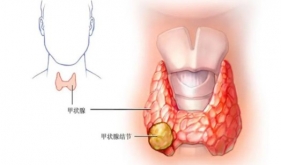 如何面对乘风破浪的甲状腺结节？