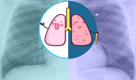 肺上长结节是不是就“癌”起了？