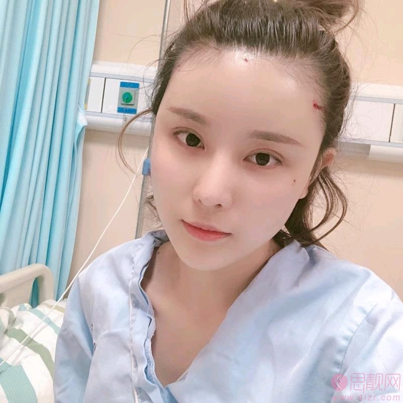 重庆美莱整形美容医院吴继东医生自体脂肪全脸填充案例分享+2021年价格表公开