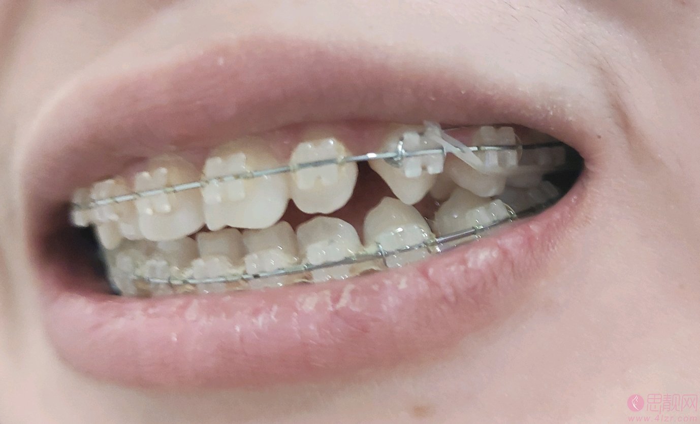 北京圣贝口腔医院矫正牙齿贵吗？2021年价格表全新发布+术后真人案例分享