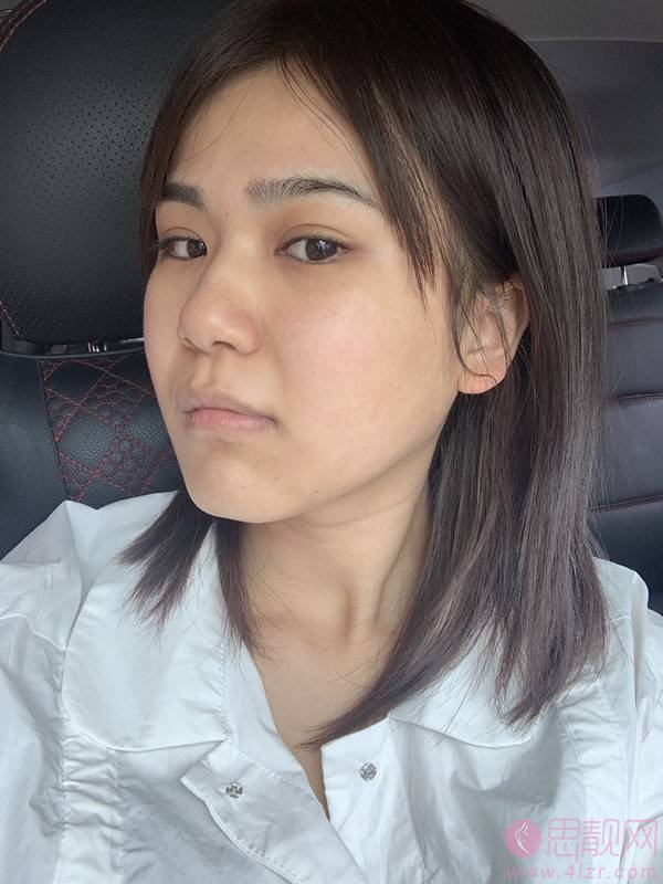 广州曙光美容医院祛斑怎么样?附祛斑前后效果对比及2021项目价格表发布