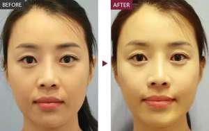 面部松弛法令纹严重怎么改善 去法令纹最好的医美方法
